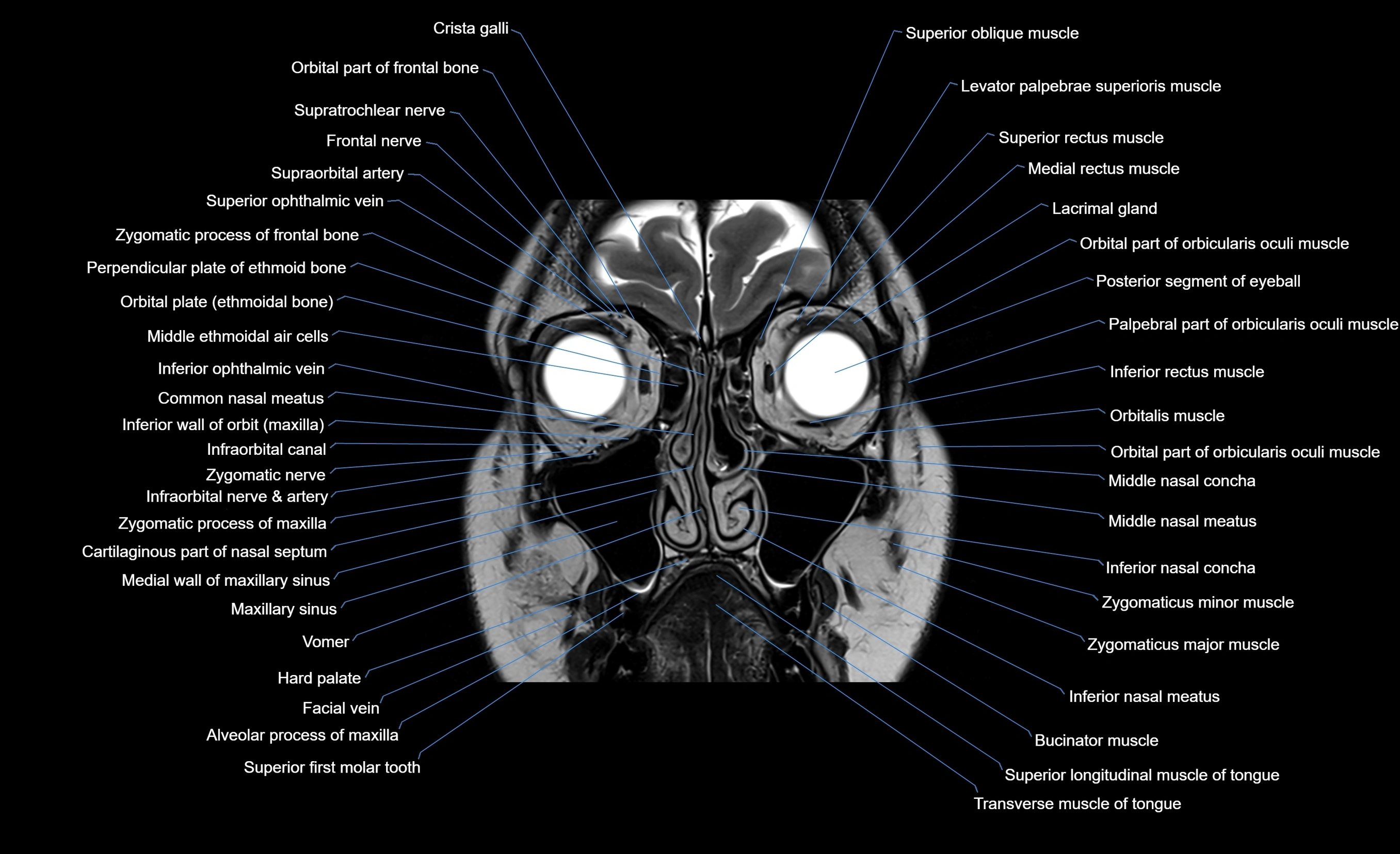 MRI face & paranasal sinuses(PNS) labelled  coronal  cross sectional anatomy 3T radiology  image-img-00001-00019.webp